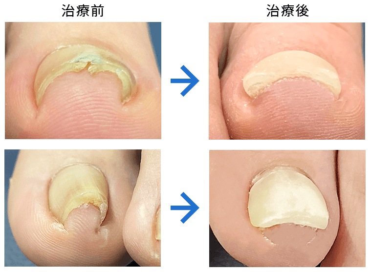 巻き爪 施術前・施術後